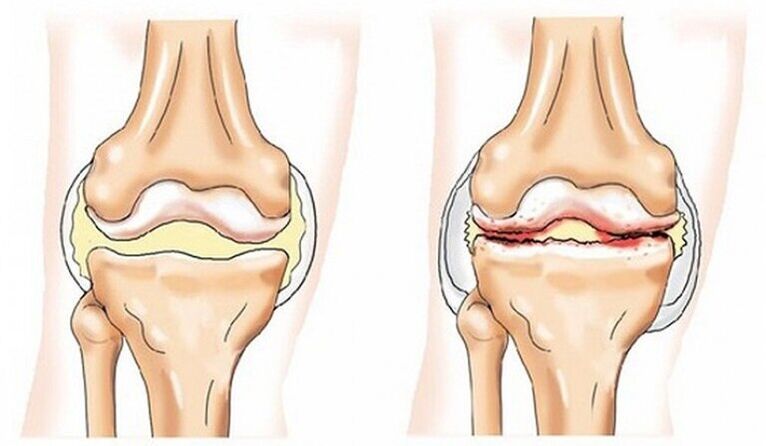 Articulation et articulation saines affectées par l'arthrose