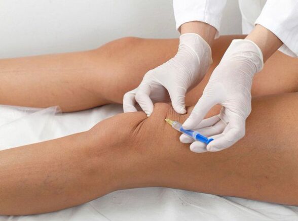 Injection intra-articulaire pour l'arthrose du genou.