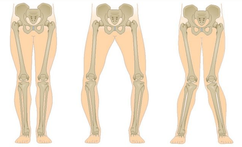 complications de l'arthrose du genou